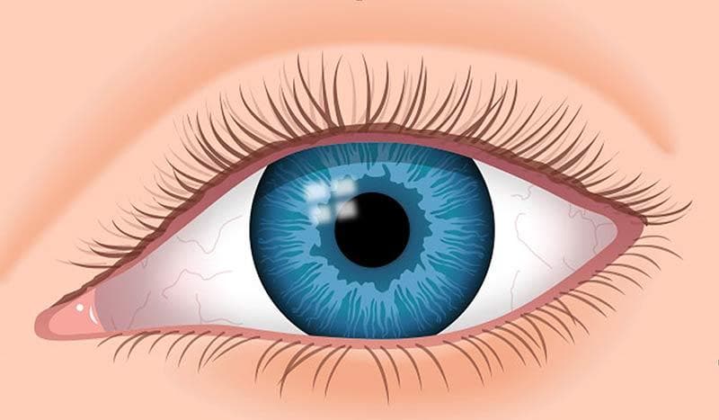 Punane silm: põhjused, ravi ja ennetamine