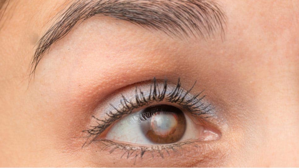 Katarakti ennetamine: 4 teaduslikult tõestatud viisi