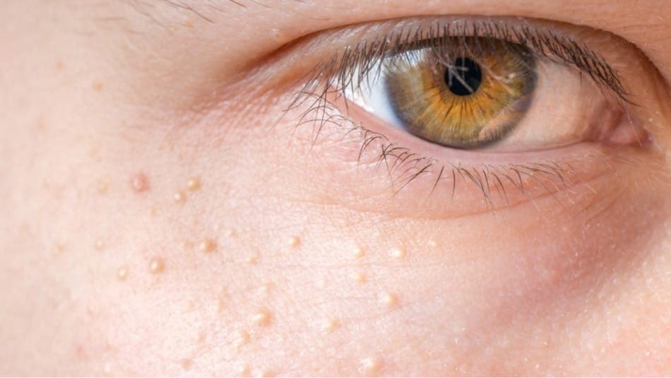 Milia näol: kuidas eristada aknest