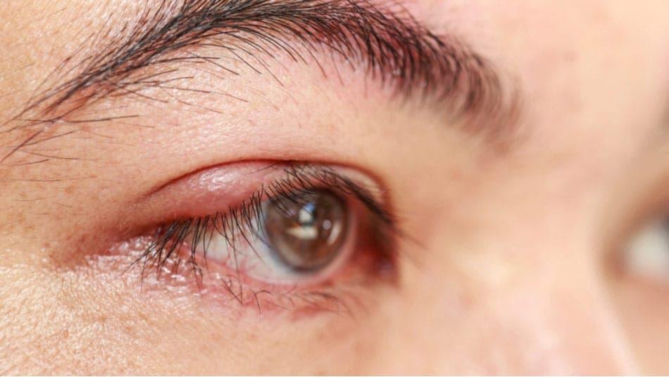 Халязион: причины, лечение и профилактика