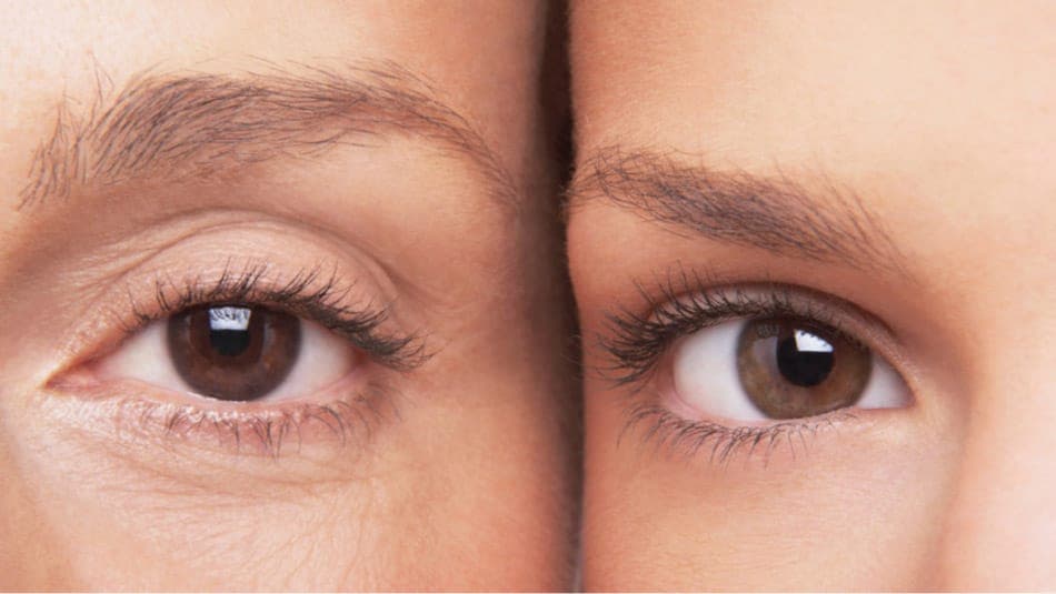 Long-Term Vision Results After Laser Eye Surgery